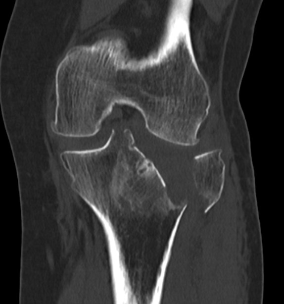 Posterolateral Tibial Plateau